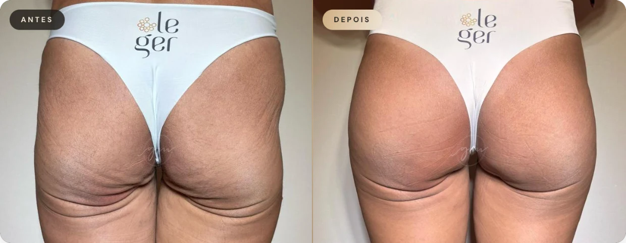Antes e depois — resultado 01 de paciente da Dra. Gina