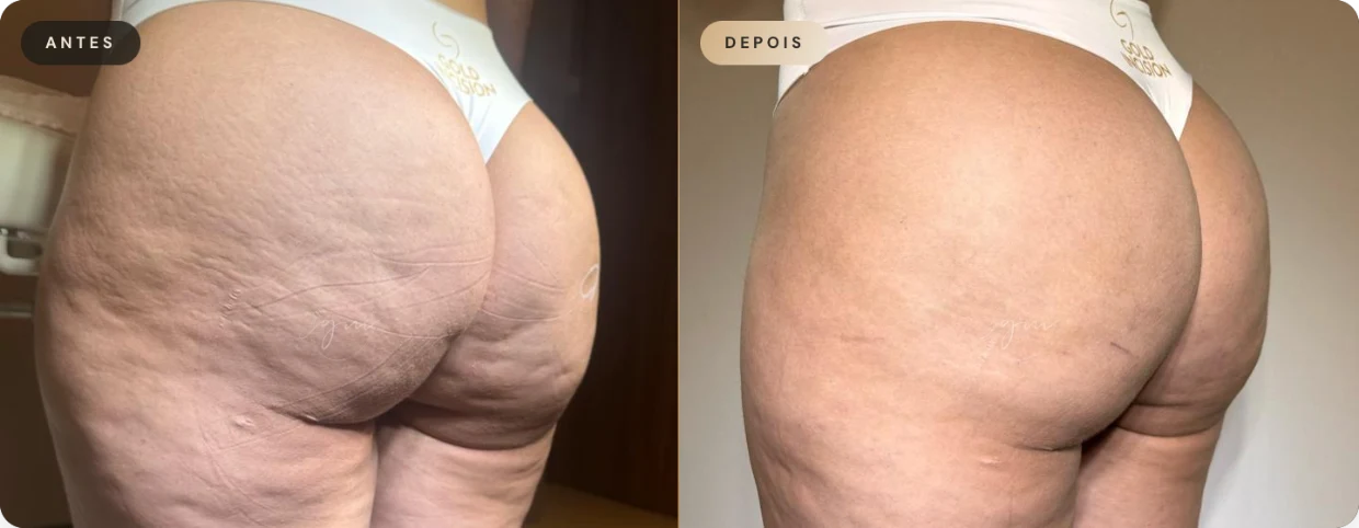 Antes e depois — resultado 02 de paciente da Dra. Gina