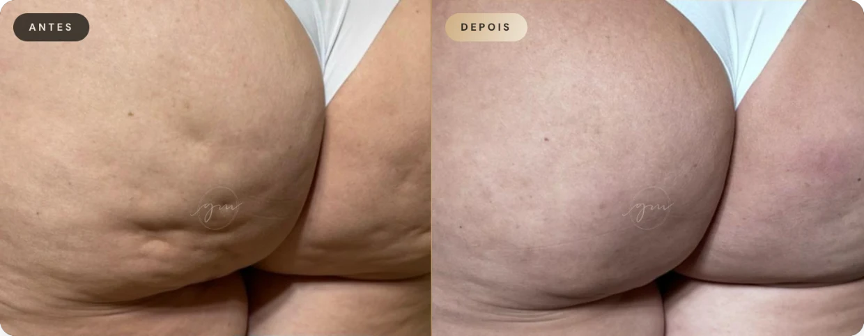 Antes e depois — resultado 03 de paciente da Dra. Gina
