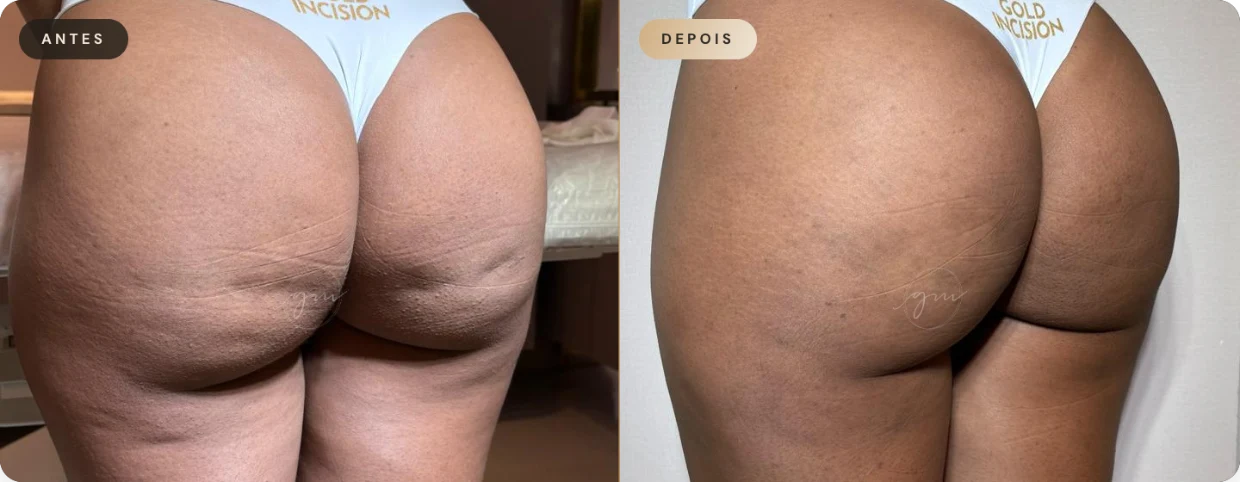 Antes e depois — resultado 04 de paciente da Dra. Gina